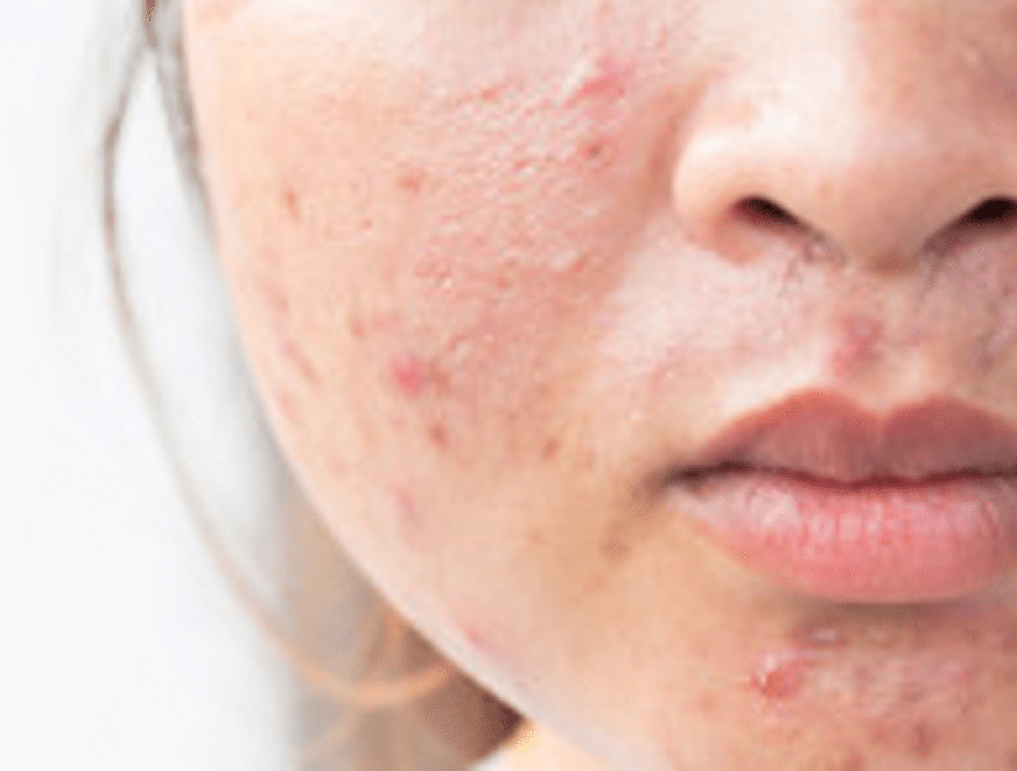 Acne: Causes & Solutions | Osprey Observer